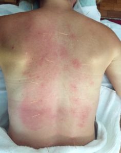 Journalists need help with their recovery, too. My back, post-cupping and acupuncture session. Thanks, Dom!